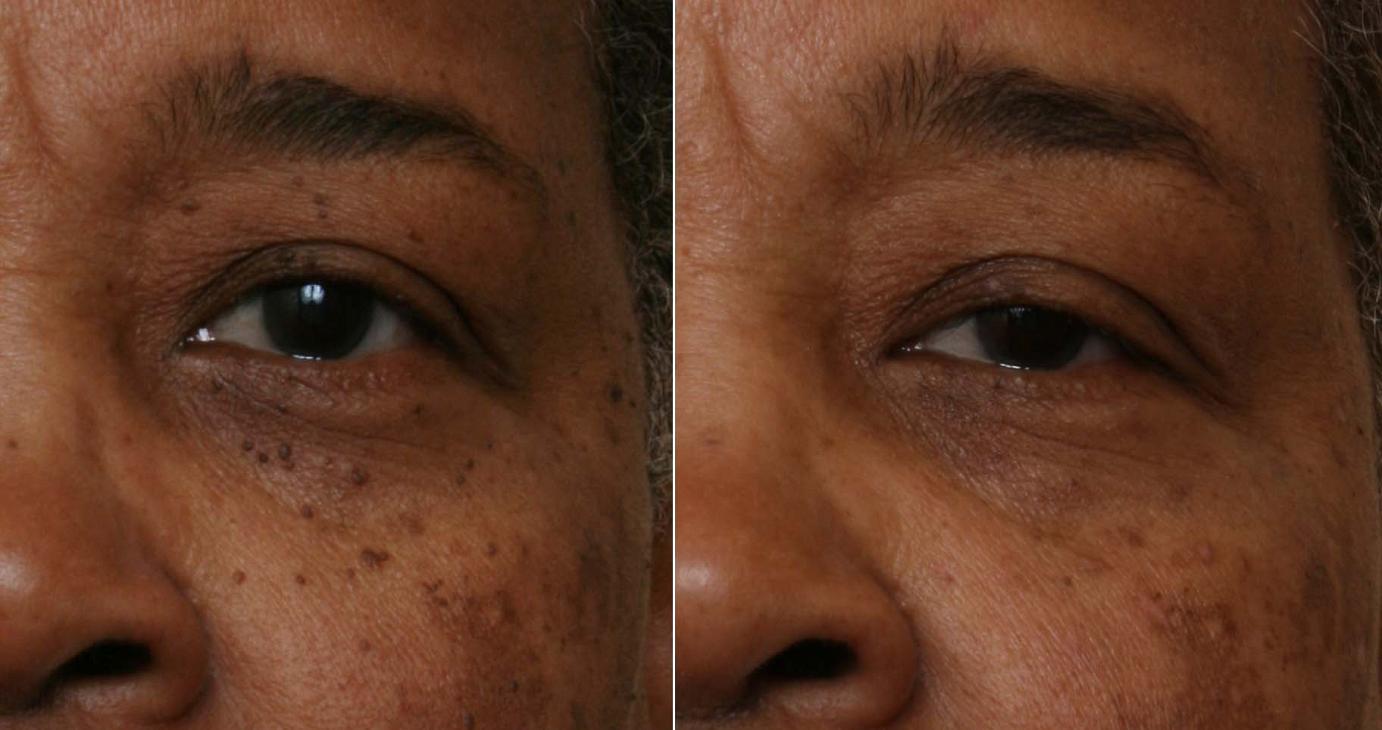 dermatosis-papulosis-nigra-before-and-after