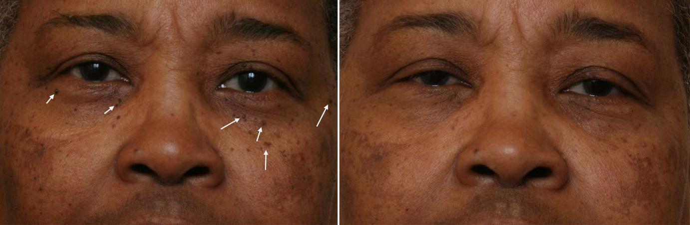 dermatosis