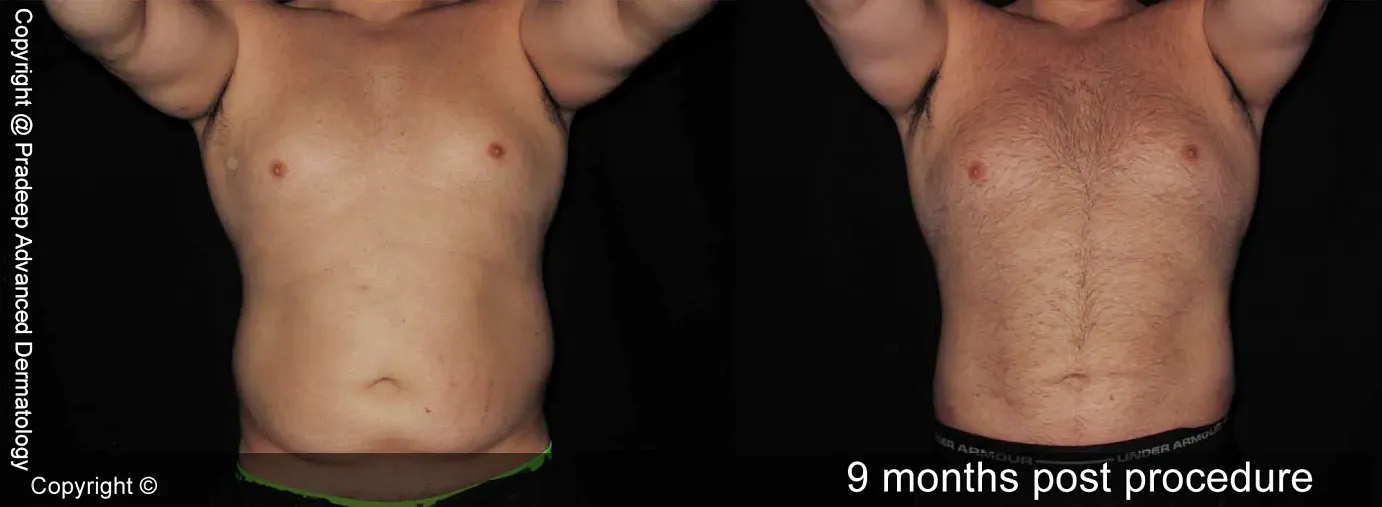 NP liposuction-man-abdomen-after-9-months