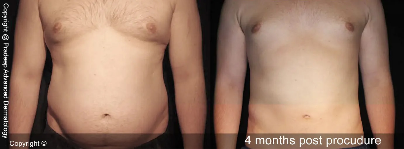 NP liposuction-man-abdomen-before-and-after