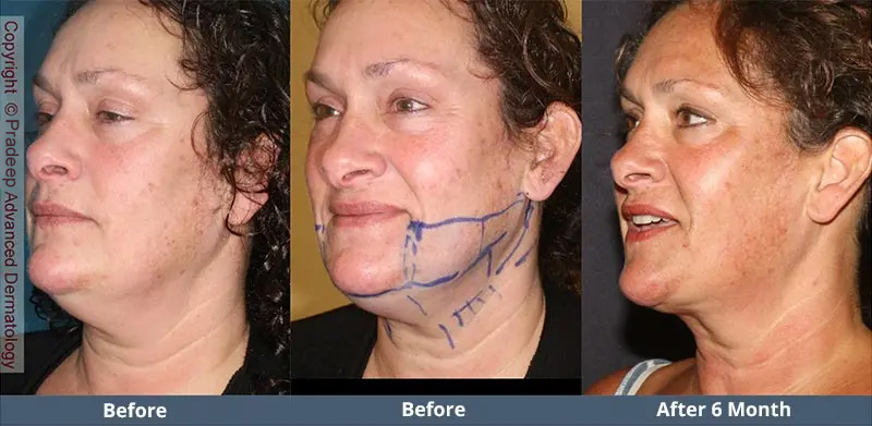 PN lipo-ba2