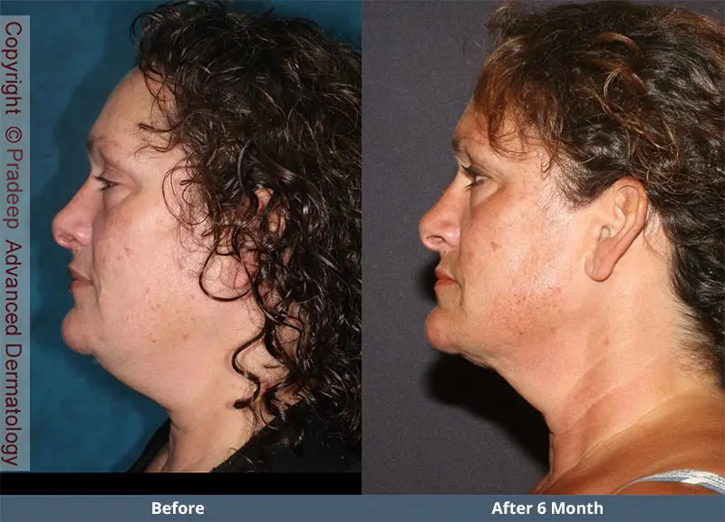PN lipo-ba3