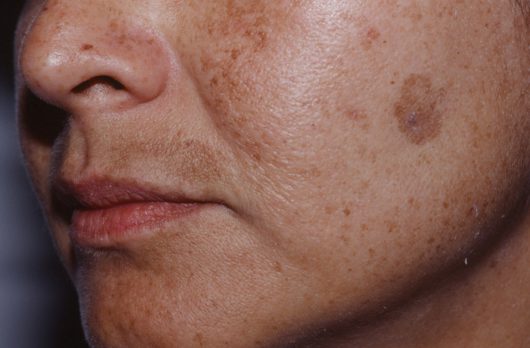 brown spots