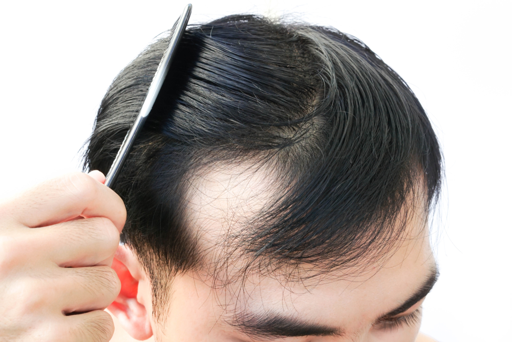 hair loss