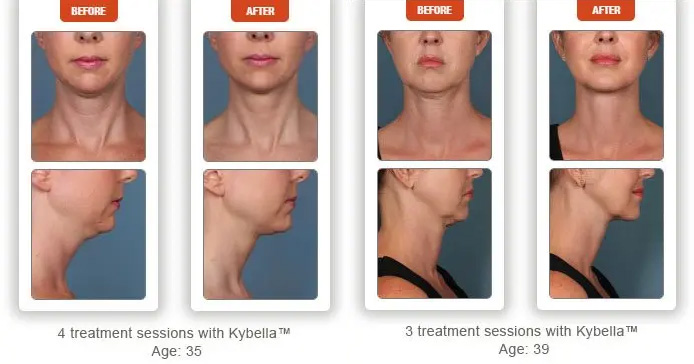 kybella 35 and 39