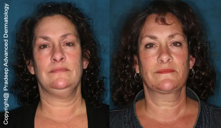 neck-lifts-before-after-front