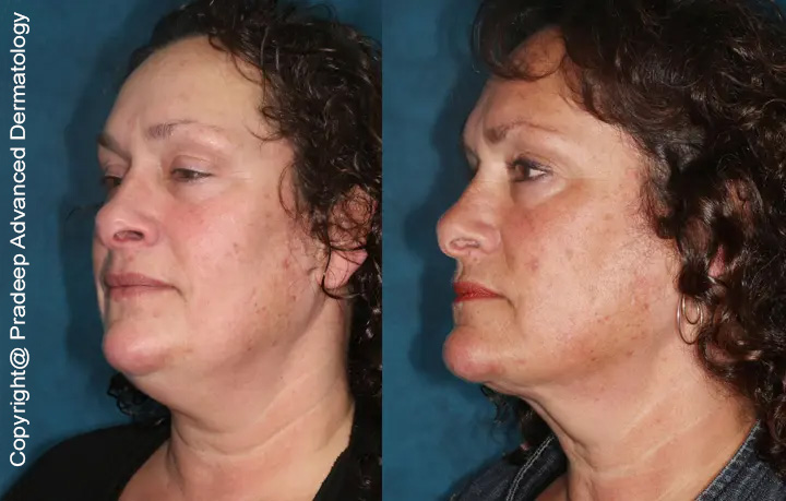 neck-lifts-before-after-half-left Ps
