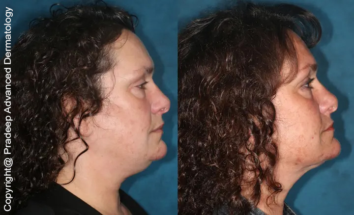neck-lifts-before-after-right PS