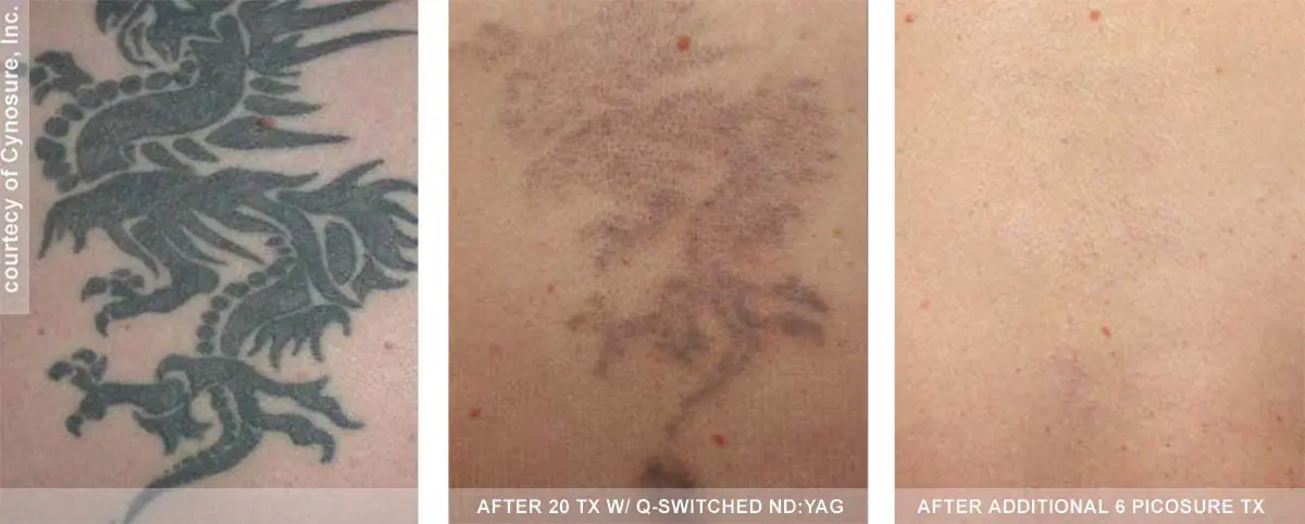 picosure-complete-removal-of-tattoo-before-and-after
