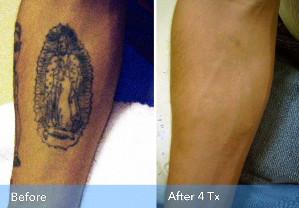 tatoo removel 1