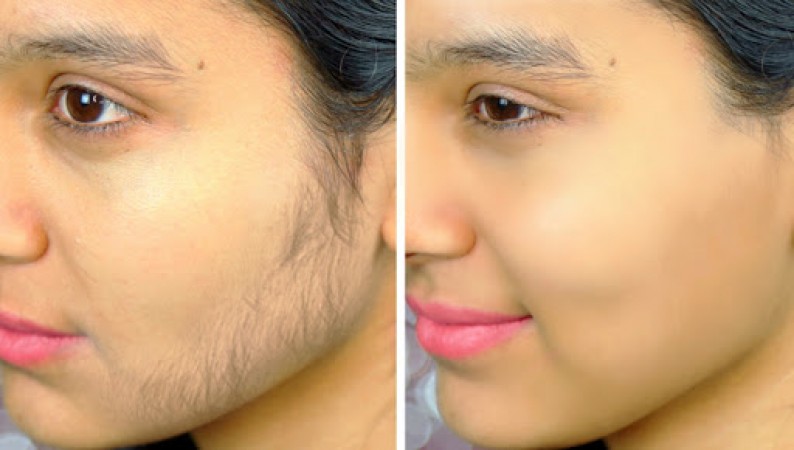 unwanted hair