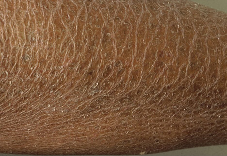 Ichthyosis scalesOpen pop-up dialog box