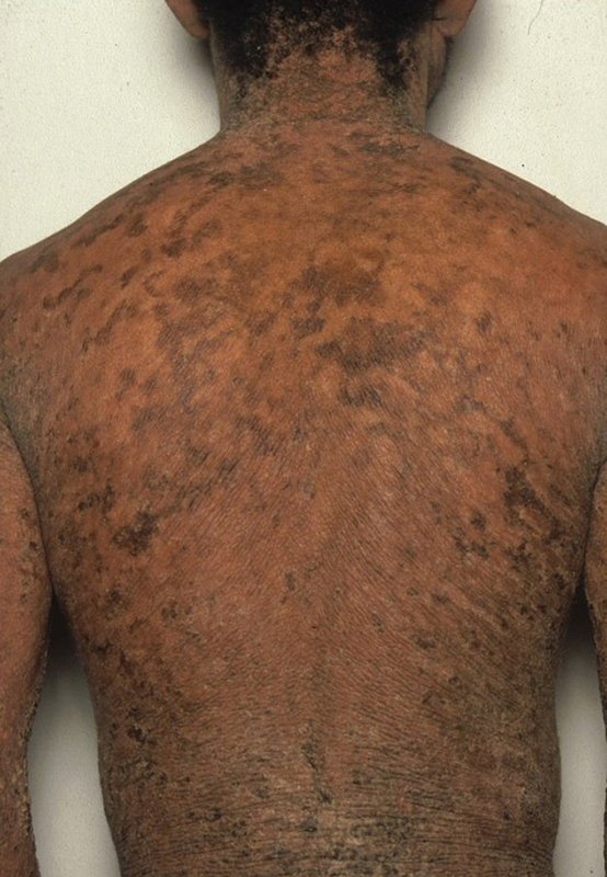 Ichthyosis vulgarisOpen pop-up dialog box